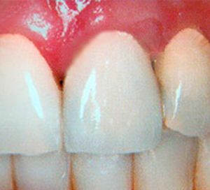 Clínica Dental Rodolfo Pita dentadura con implante