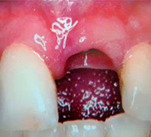 Clínica Dental Rodolfo Pita dentadura sin diente