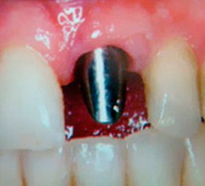 Clínica Dental Rodolfo Pita tratamiento implante