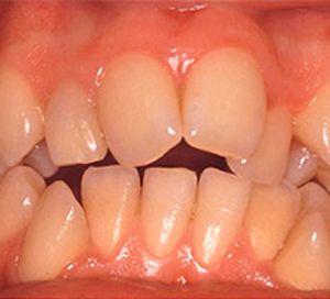 Clínica Dental Rodolfo Pita dientes desalineados