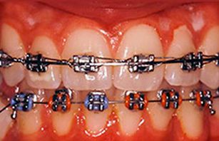 Clínica Dental Rodolfo Pita dientes con brackets2